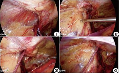 Clinical efficacy of laparoscopic closed hernia ring combined with a patch repair for Gilbert type III indirect inguinal hernia